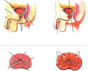 prostatës normale dhe prostatitit kronik