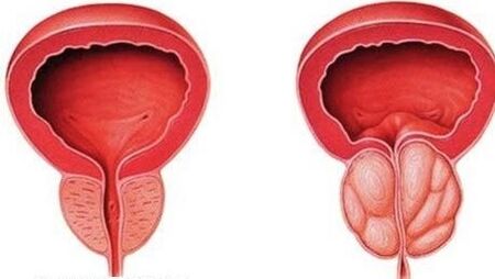 prostata normale dhe e pezmatuar