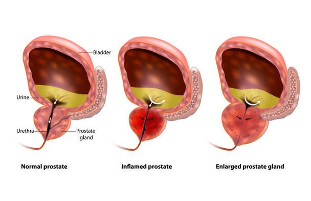 prostatiti është një inflamacion i gjëndrës së prostatës