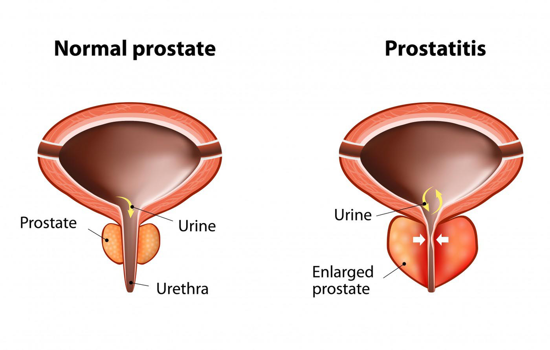 Prostata normale e një njeriu të shëndetshëm dhe inflamacion i gjëndrës së prostatës me prostatit
