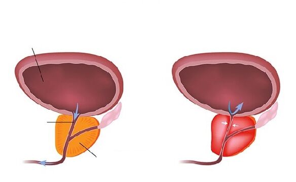 prostatës normale dhe të përflakur